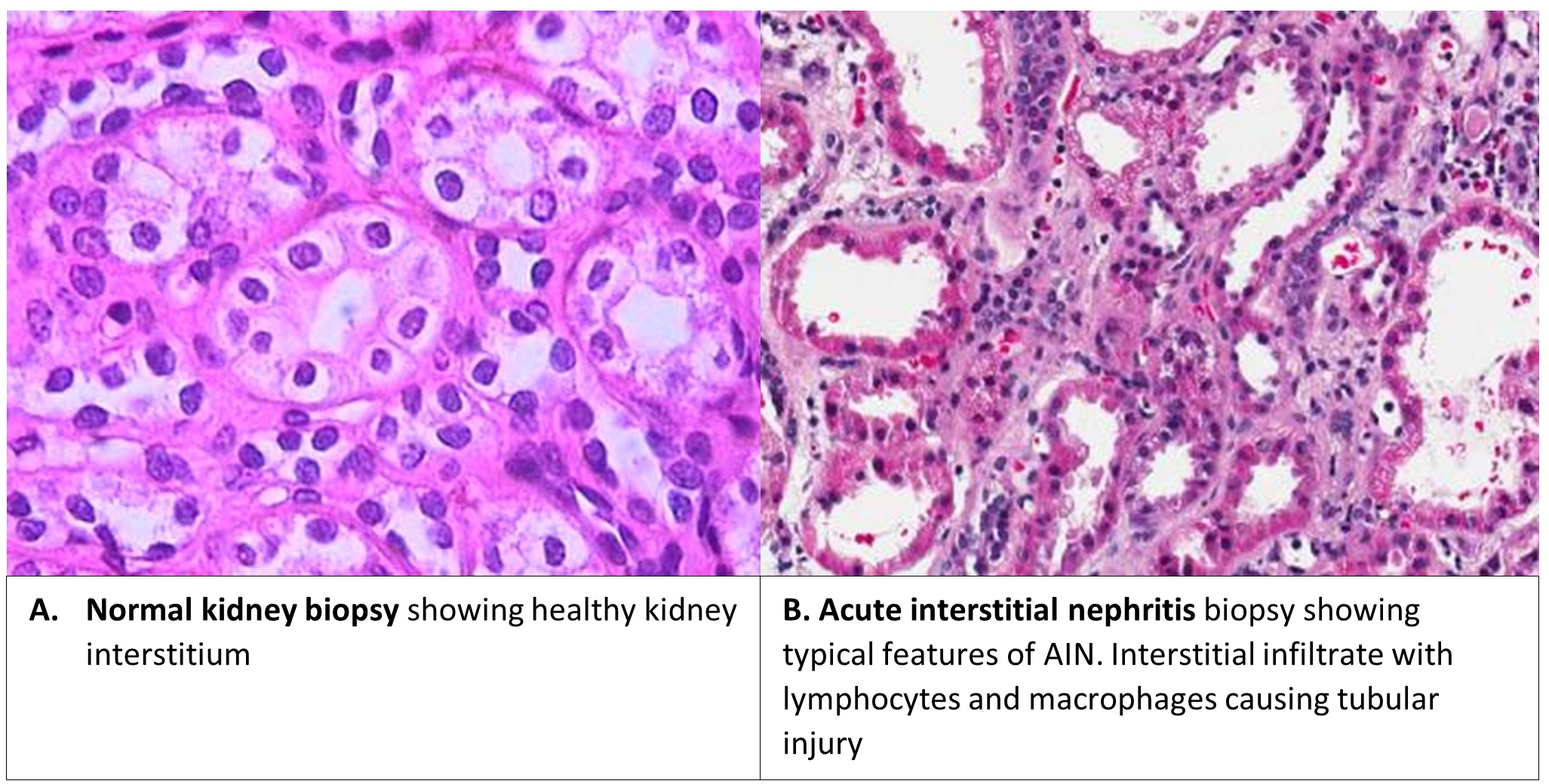 AIN histology